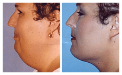 Liposuction Before and After Photos