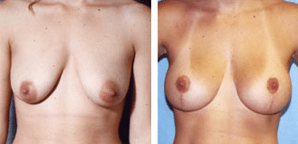 Breast Lift Before and After Photos