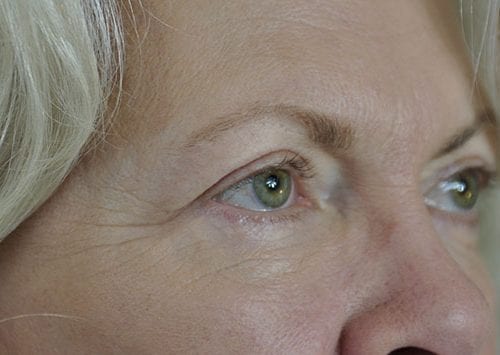 Blepharoplasty Patient 07 - After 