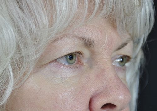 Blepharoplasty Patient 07 - Before 