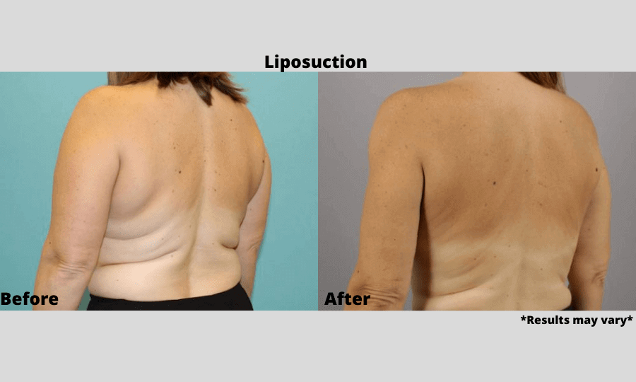 Before and after image showing the results of liposuction on the back performed in Scottsdale, AZ.