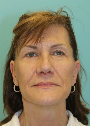 Face Lift Patient 03 - After Thumbnail