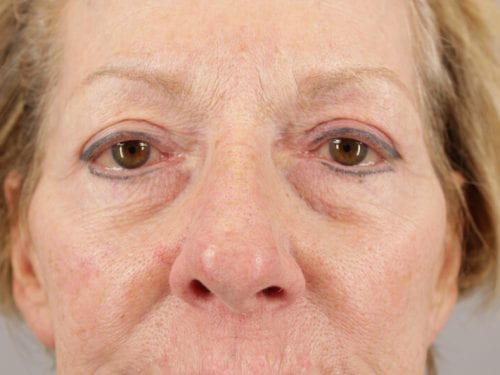 Blepharoplasty Patient 06 - After Thumbnail