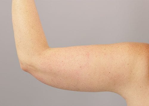 Arm Lift Patient 03 - After Thumbnail