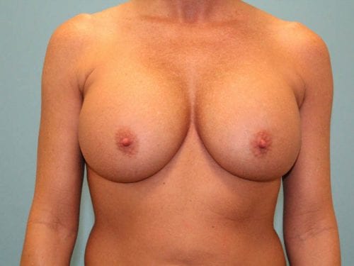 Breast Augmentation Patient 10 - After Thumbnail