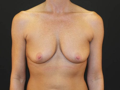 Breast Augmentation Patient 10 - Before Thumbnail