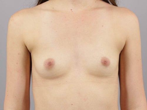 Breast Augmentation Patient 02 - Before Thumbnail