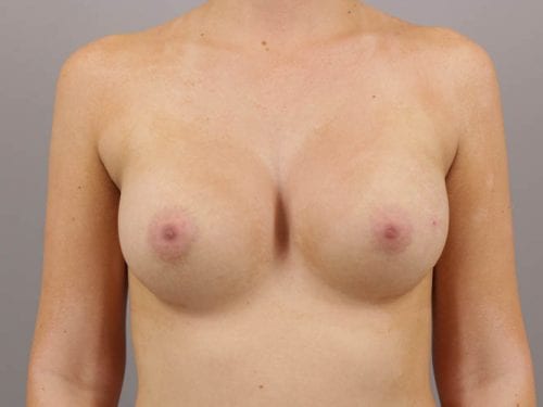 Breast Augmentation Patient 02 - After Thumbnail