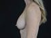 Breast Revision Patient 13 - Before Thumbnail 