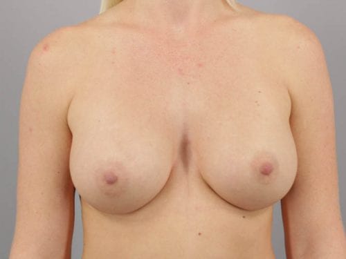Breast Augmentation Patient 07 - After Thumbnail
