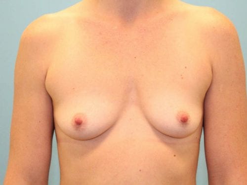 Breast Augmentation Patient 07 - Before Thumbnail