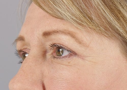 Blepharoplasty Patient 08 - After 