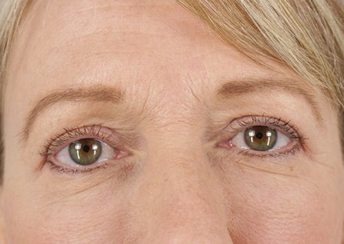 Blepharoplasty Patient 08 - After Thumbnail