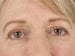 Blepharoplasty Patient 08 - After Thumbnail 