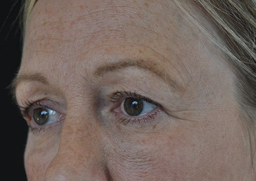 Blepharoplasty Patient 08 - Before 