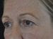 Blepharoplasty Patient 08 - Before Thumbnail 