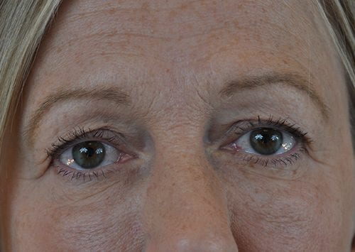 Blepharoplasty Patient 08 - Before Thumbnail