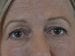 Blepharoplasty Patient 08 - Before Thumbnail 