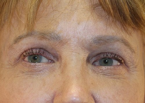 Blepharoplasty Patient 09 - After Thumbnail