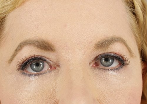 Blepharoplasty Patient 10 - After 