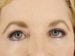 Blepharoplasty Patient 10 - After Thumbnail 