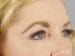 Blepharoplasty Patient 10 - After Thumbnail 