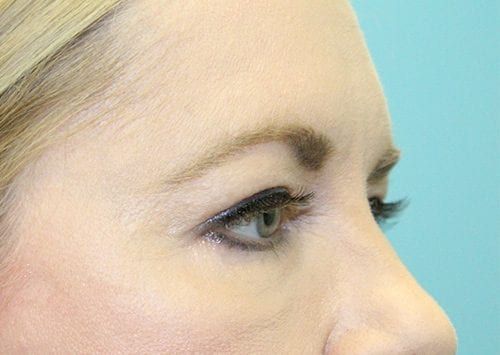 Blepharoplasty Patient 10 - Before 