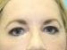 Blepharoplasty Patient 10 - Before Thumbnail 