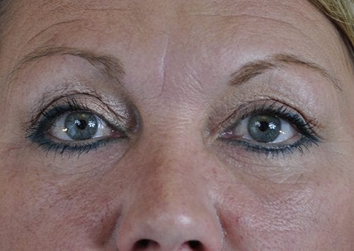 Blepharoplasty Patient 11 - After Thumbnail