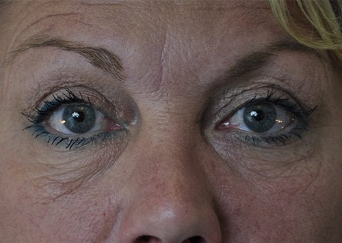 Blepharoplasty Patient 11 - Before Thumbnail