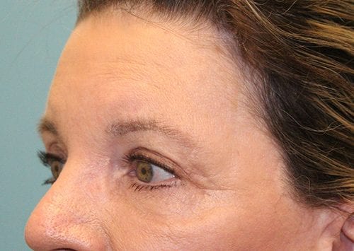 Blepharoplasty Patient 12 - After 