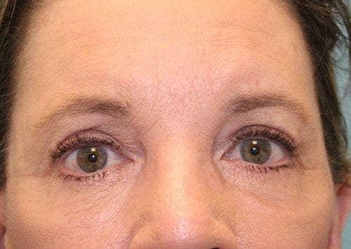 Blepharoplasty Patient 12 - After 