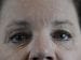 Blepharoplasty Patient 12 - Before Thumbnail 