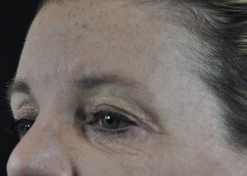 Blepharoplasty Patient 12 - Before 