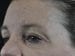 Blepharoplasty Patient 12 - Before Thumbnail 