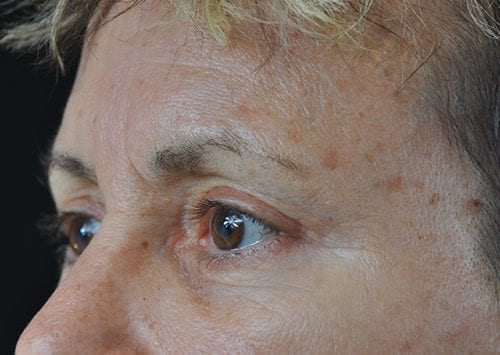 Blepharoplasty Patient 13 - After 