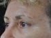 Blepharoplasty Patient 13 - After Thumbnail 