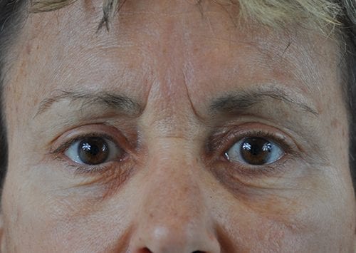 Blepharoplasty Patient 13 - After 