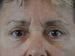 Blepharoplasty Patient 13 - After Thumbnail 