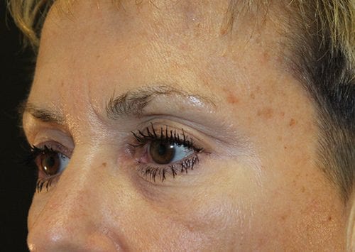 Blepharoplasty Patient 13 - Before 