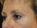 Blepharoplasty Patient 13 - Before Thumbnail 