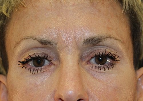 Blepharoplasty Patient 13 - Before 