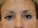 Blepharoplasty Patient 13 - Before Thumbnail 