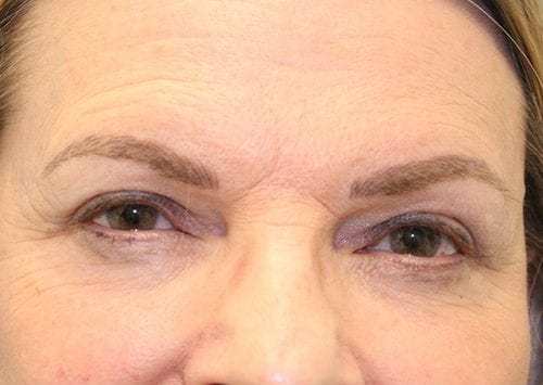 Blepharoplasty Patient 14 - After Thumbnail