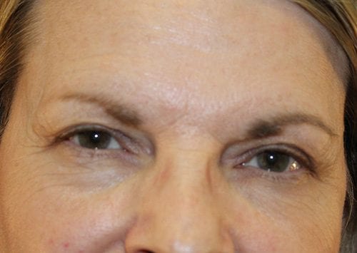 Blepharoplasty Patient 14 - Before Thumbnail