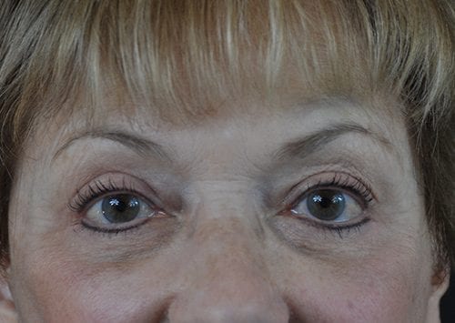 Blepharoplasty Patient 15 - After 