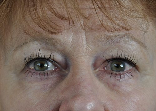 Blepharoplasty Patient 16 - Before 