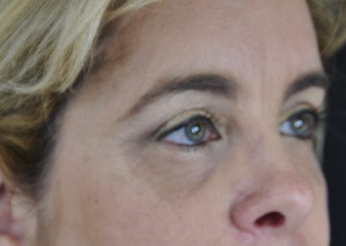 Blepharoplasty Patient 18 - After 