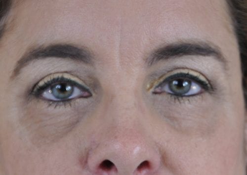 Blepharoplasty Patient 18 - After 