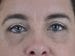 Blepharoplasty Patient 18 - After Thumbnail 